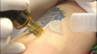 Think Before You Ink: My Painfully Expensive Tattoo Removal Process