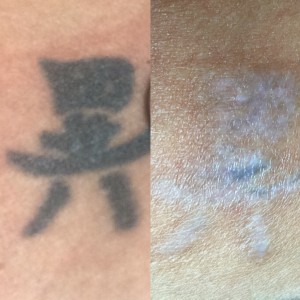 tattoo removal result